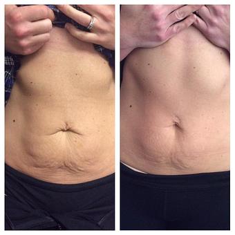 Product: Body Contouring Before After - Zen Aesthetics and Wellness in Sycamore Square - Edmond, OK Day Spas