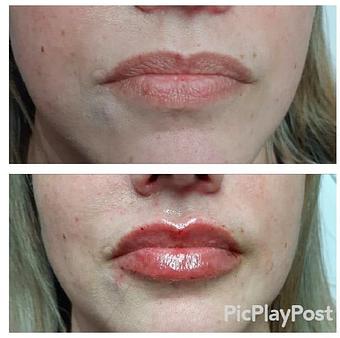 Product: Before After Lip Filler (Restylane Filler) - Zen Aesthetics and Wellness in Sycamore Square - Edmond, OK Day Spas
