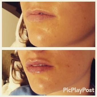 Product: Before After Lip Filler (Juvederm) - Zen Aesthetics and Wellness in Sycamore Square - Edmond, OK Day Spas