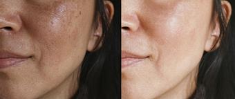 Product: Chemical Peels Range from Mild to MD peels. - Zen Aesthetics and Wellness in Sycamore Square - Edmond, OK Day Spas