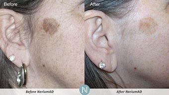Product: diminishes age spots and uneven skin tone - A Total Image Solution in Spanaway, WA Day Spas