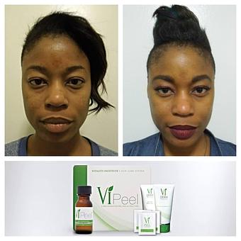 Product: Before & After Vi peel. - Lavender The Skin Care Place in North Miami Beach, FL Skin Care Products & Treatments