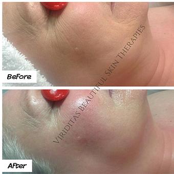 Product: before and after custom Level 4 Facial - Viriditas Beautiful Skin Therapies in Historic East Side of Providence - Providence, RI Skin Care Products & Treatments