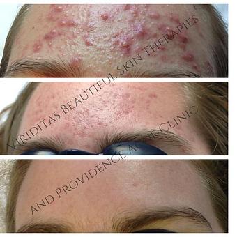 Product: Before and after severe inflamed acne - Viriditas Beautiful Skin Therapies in Historic East Side of Providence - Providence, RI Skin Care Products & Treatments