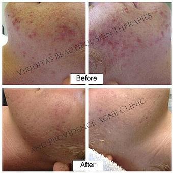 Product: Before and after moderate mixed inflamed and non-inflamed acne - Viriditas Beautiful Skin Therapies in Historic East Side of Providence - Providence, RI Skin Care Products & Treatments