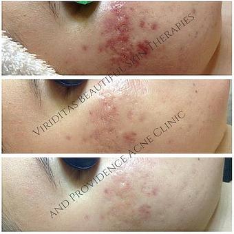Product: Before and after severe inflamed cystic acne - Viriditas Beautiful Skin Therapies in Historic East Side of Providence - Providence, RI Skin Care Products & Treatments