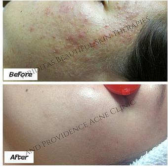 Product: Acne before and after - Viriditas Beautiful Skin Therapies in Historic East Side of Providence - Providence, RI Skin Care Products & Treatments