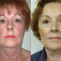 Facelift Result
