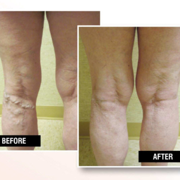Portfolio - USA Vein Clinics - Photo (64165)