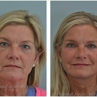 Before and after facelift