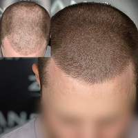Photos of Our Business - Zang SMP - Scalp Micropigmentation Orange County - Photo (185860)