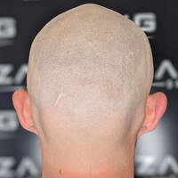 Photos of Our Business - Zang SMP - Scalp Micropigmentation Orange County - Photo (185861)