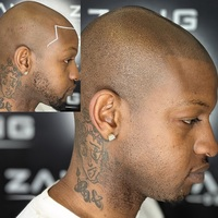 Photos of Our Business - Zang SMP - Scalp Micropigmentation Orange County - Photo (185863)