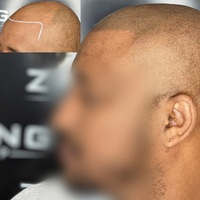 Photos of Our Business - Zang SMP - Scalp Micropigmentation Orange County - Photo (185864)