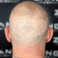 Photos of Our Business - Zang SMP - Scalp Micropigmentation Orange County - Photo (185866)